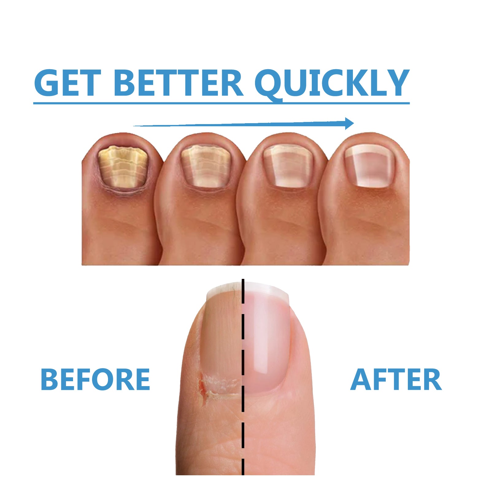 Toenail Fungus Treatment, Repair The Brotherhood Of Nails Rotten Jiasheng Mail This Soft Armour A Detailer