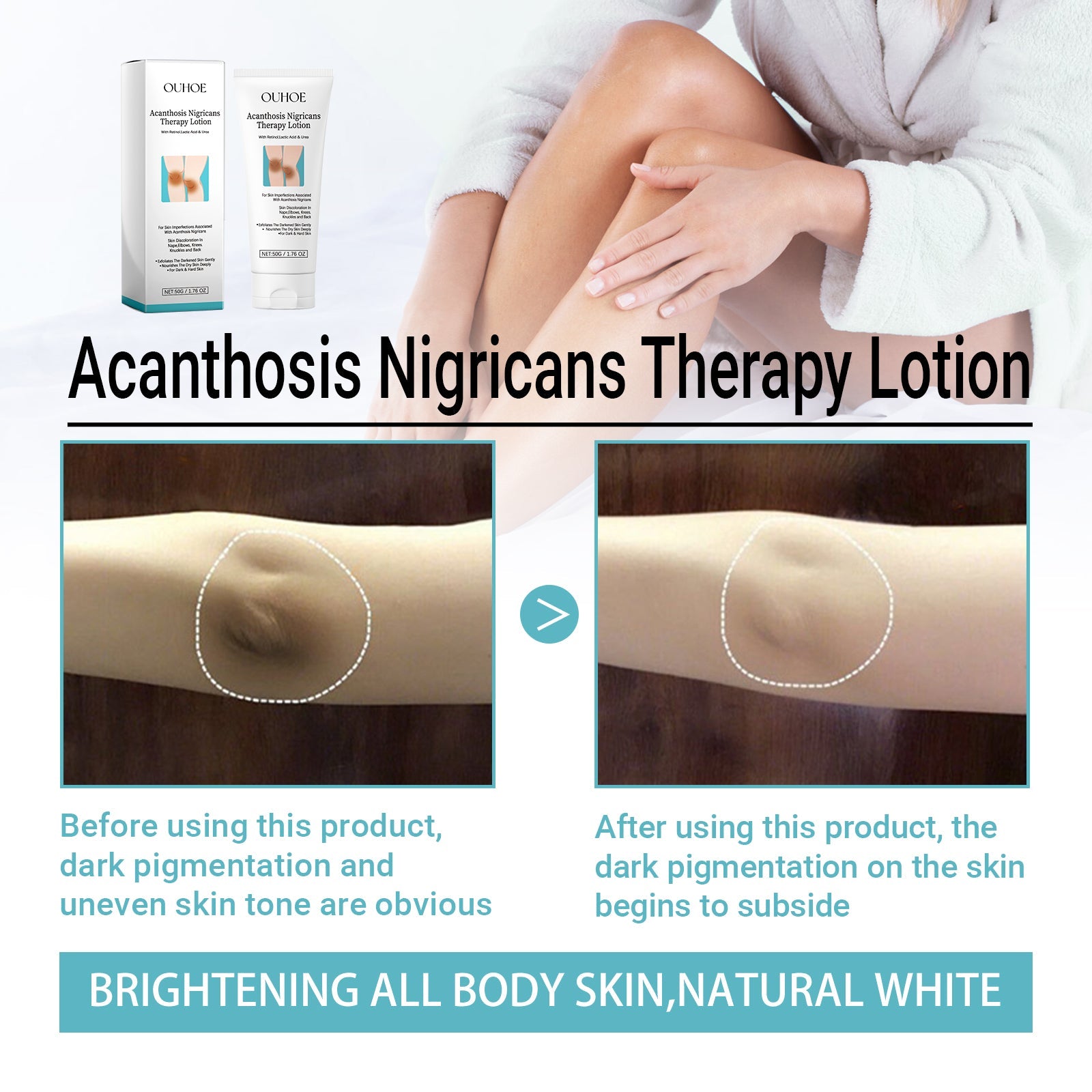 Acanthosis Nigricans Therapy Lotion, Skin Moisturizing Clean Black Dark Heavy Alar Knee Joint Repair Carry Bright Color Of Skin