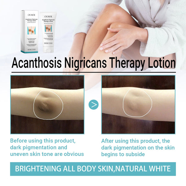 Acanthosis Nigricans Therapy Lotion, Skin Moisturizing Clean Black Dark Heavy Alar Knee Joint Repair Carry Bright Color Of Skin