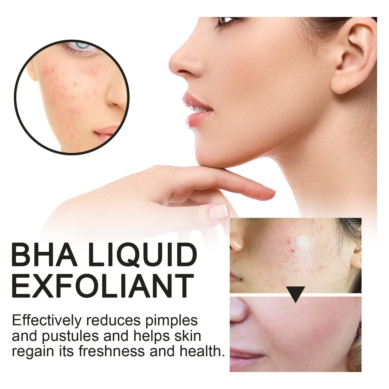 BHA Liquid Exfoliant, Lightening Acne Seal Pore-Tightening And Moisturizing Skin Essence
