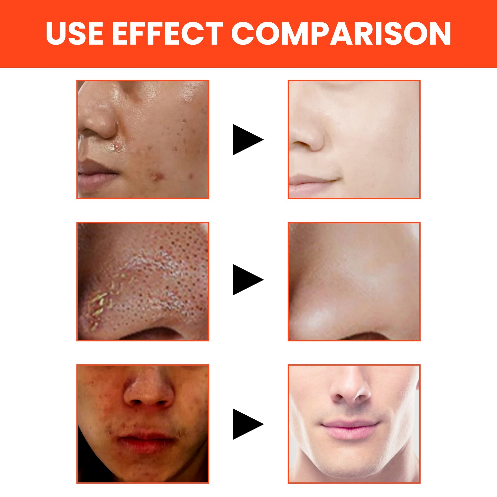 Men's Volcanic Face Wash, Acne Blackhead Face Deep Clean Pores And Oil Control