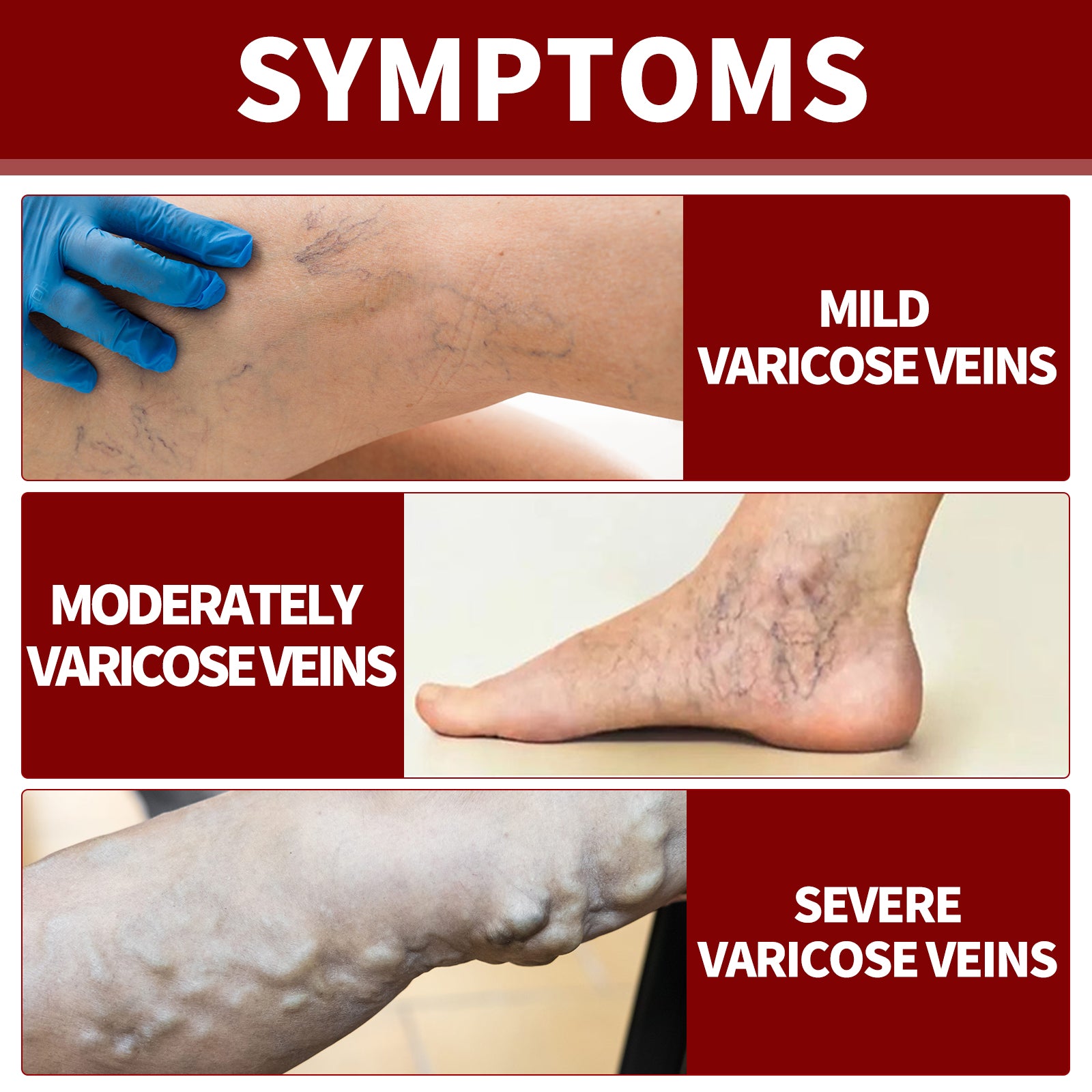 Veinmist Varicose Spray, Relief Sore Legs Massage Earthworm Leg Vein Treatment Spray