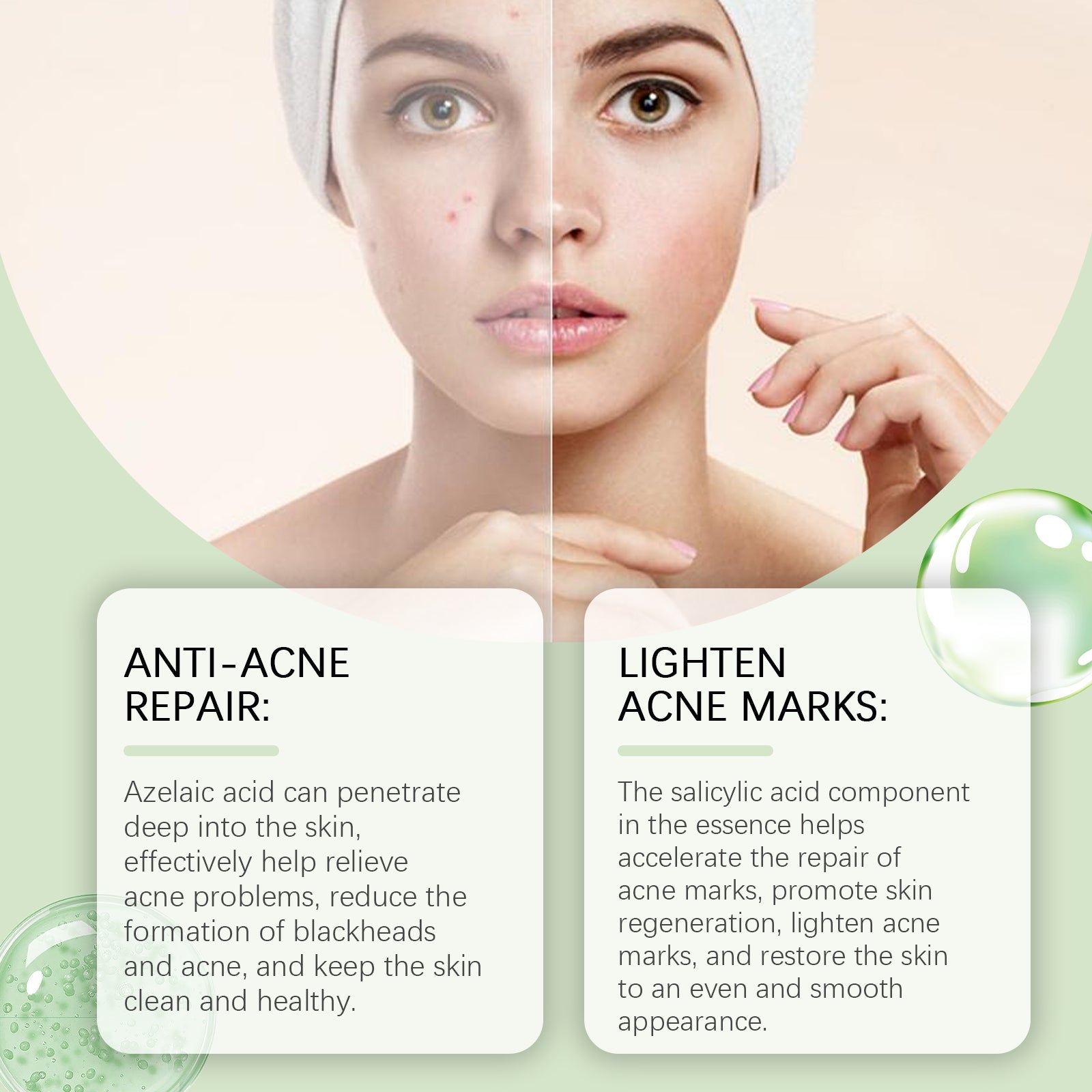 Azelaic Acid Facial Essence Moisturizes And Improves The Skin For Blackheads And Acne