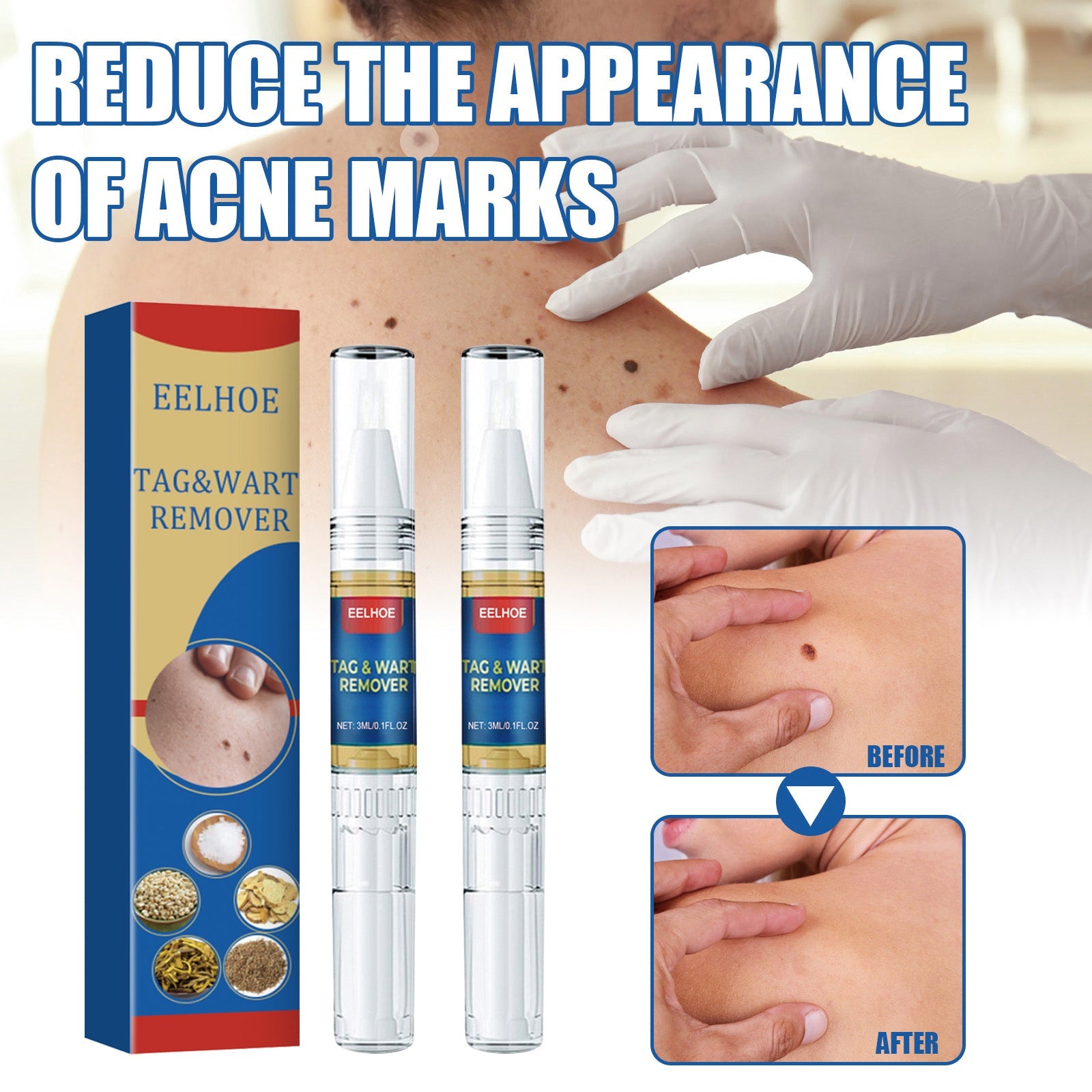 Skin Kayo Pen Gentle Body Tag Remover Cleansing Skin Care Pen