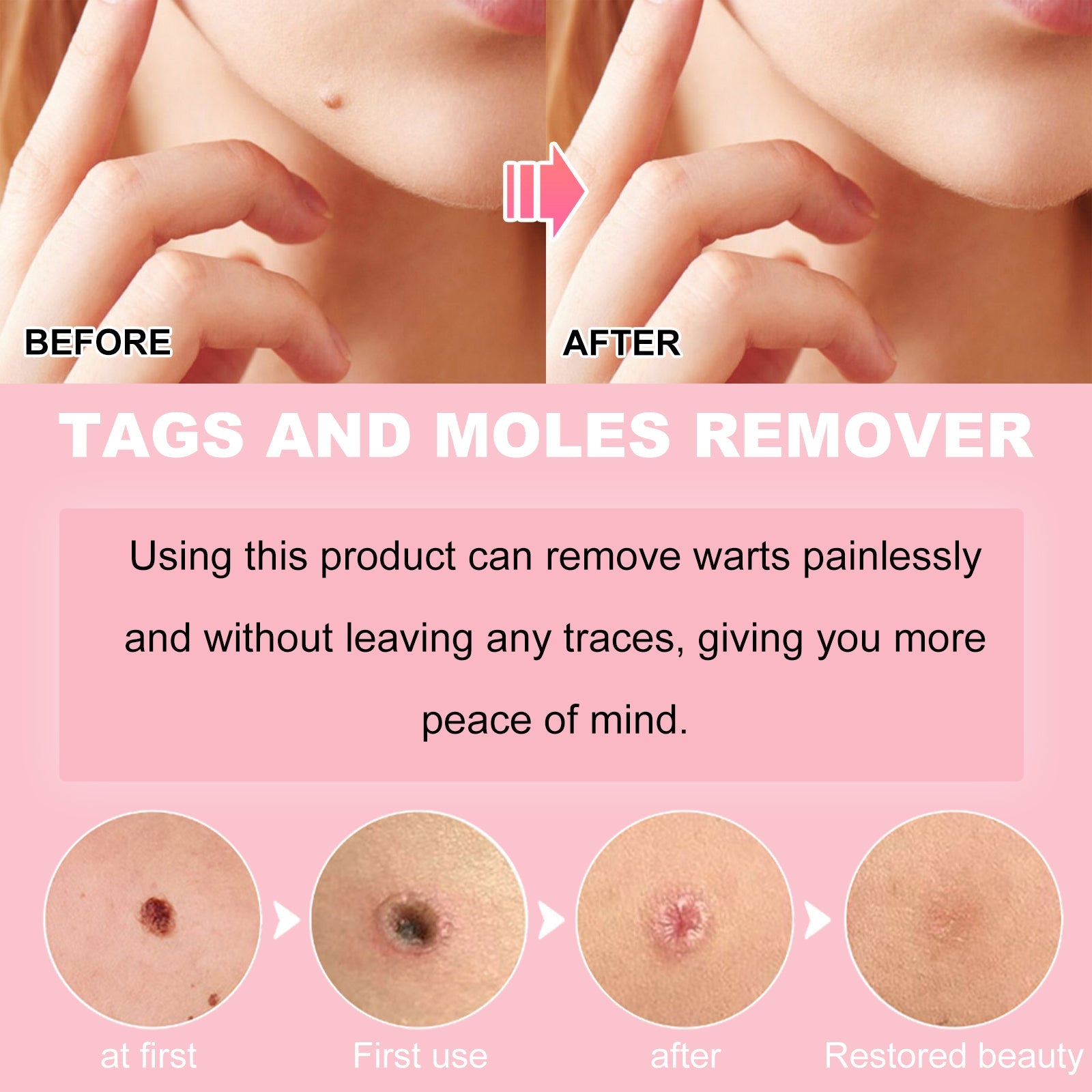 Skin Wart Lotion, Cleanses Skin And Removes Flat Eye Wart Lotion Especially Hand Cocoon