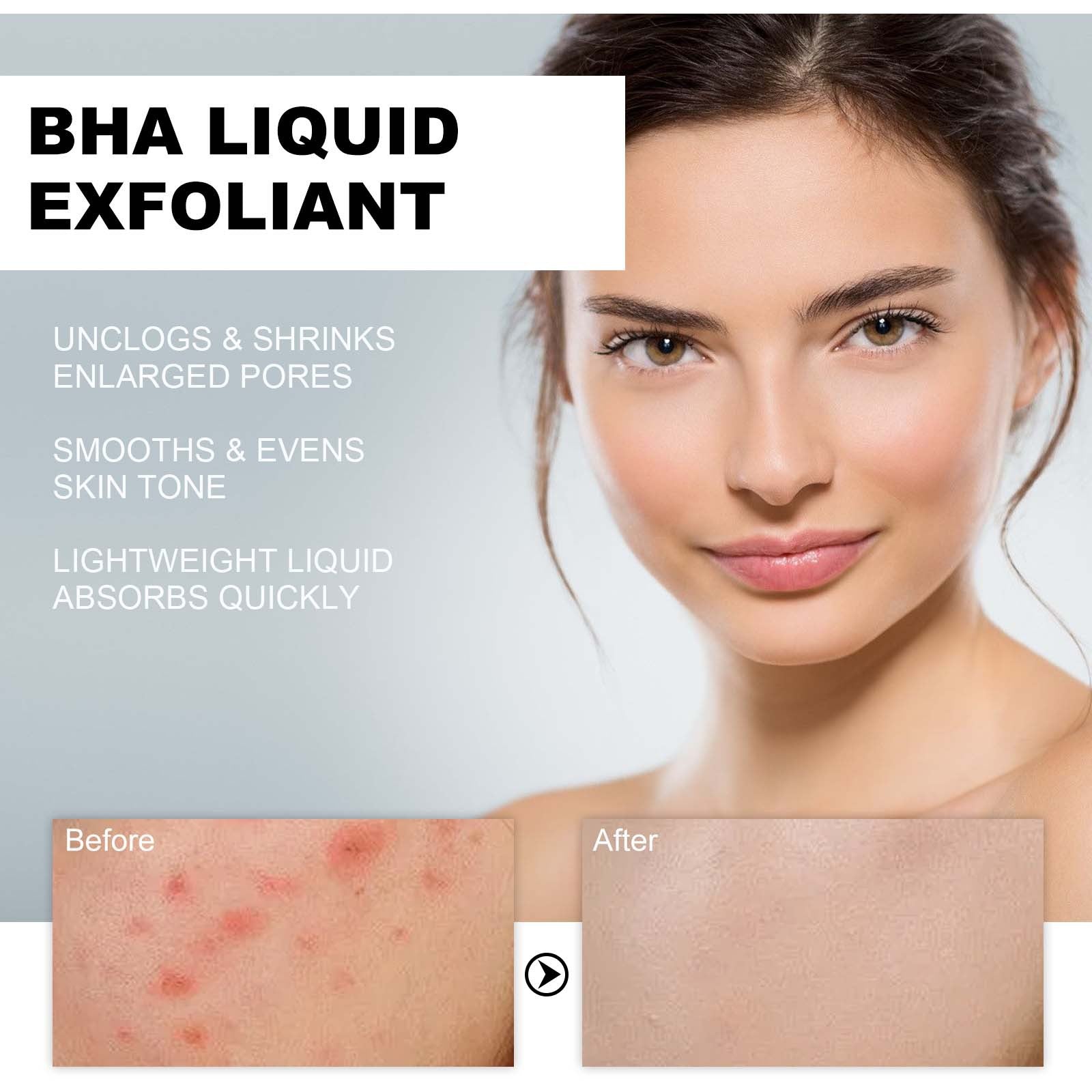 BHA Liquid Exfoliant, Lightening Acne Seal Pore-Tightening And Moisturizing Skin Essence