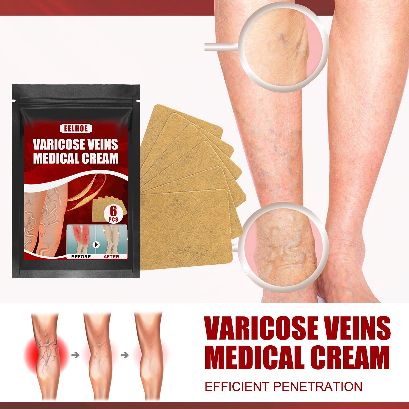 Aricose Veins Medical Cream, Relieve Leg Swelling Earthworm Leg Vein Massage To Relieve Pain