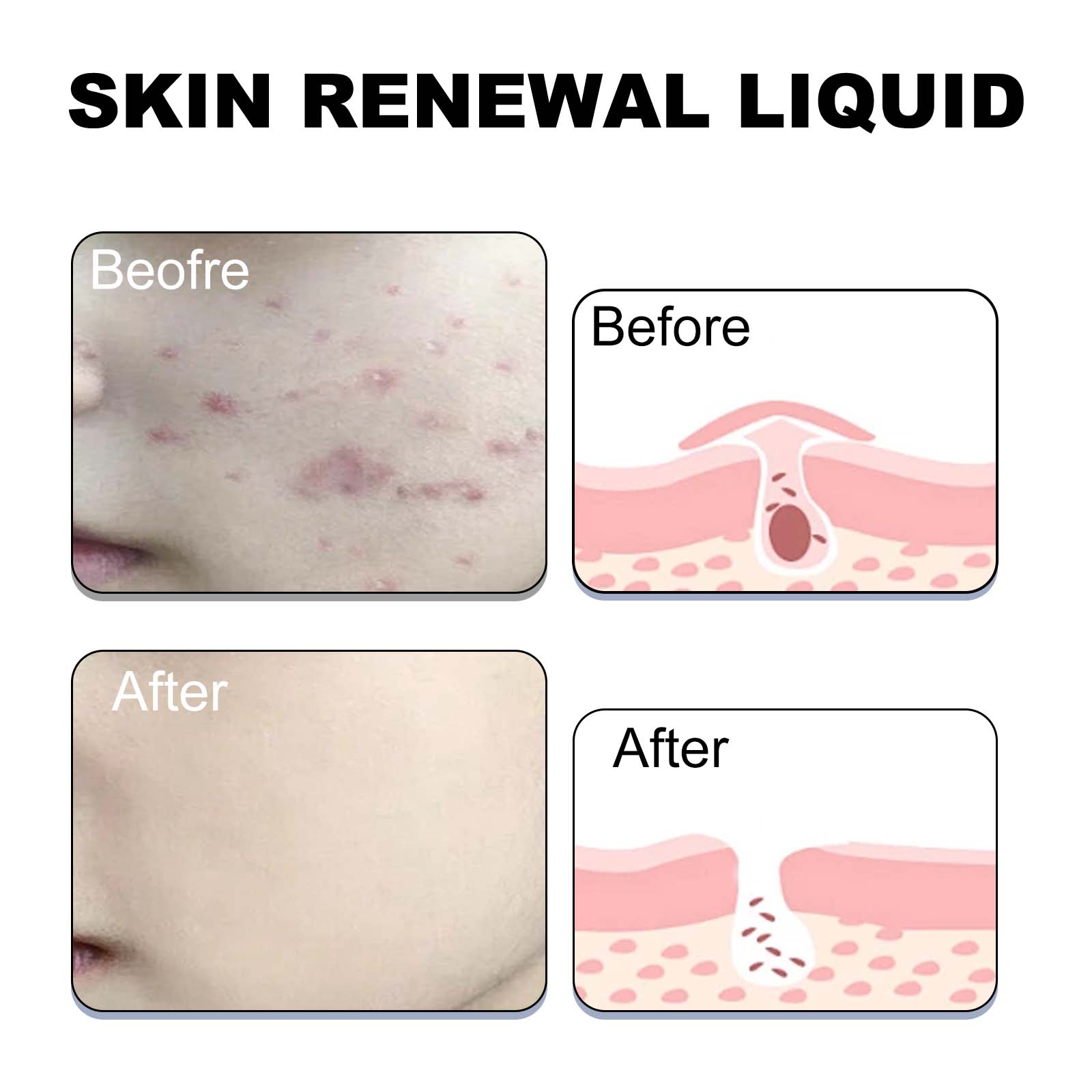 Skin Renewal Liquid, Reduce Acne Print Repair Acne Muscle Mild Clear Acne Hydrating Essence
