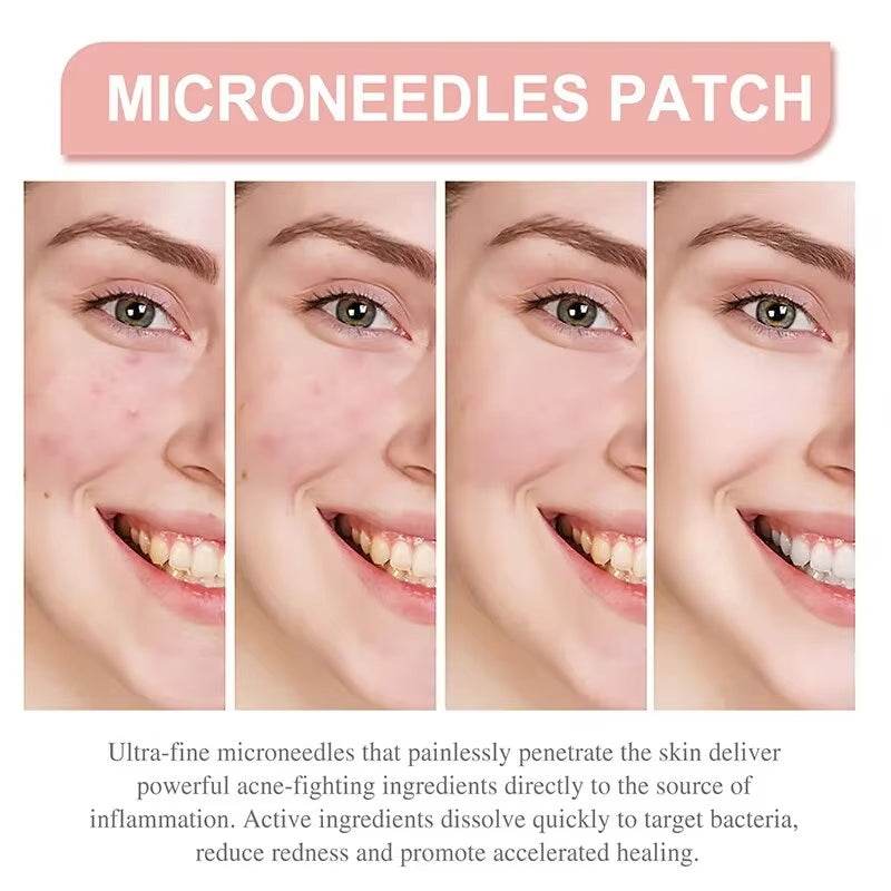 Acne Spot Healing Patches – Invisible Waterproof Stickers for Pimple Removal, Marks, and Scar Care