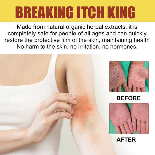 Breaking Itch King, Relieve Hand And Foot Moss Skin Moss Redness Repair Skin Itching Skin Care Cream