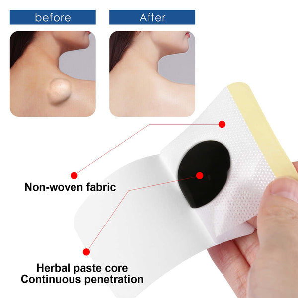 Lipoma Removal Patch, Soothing Various Body Fat Knots To Remove Subcutaneous Lumps Care Patch