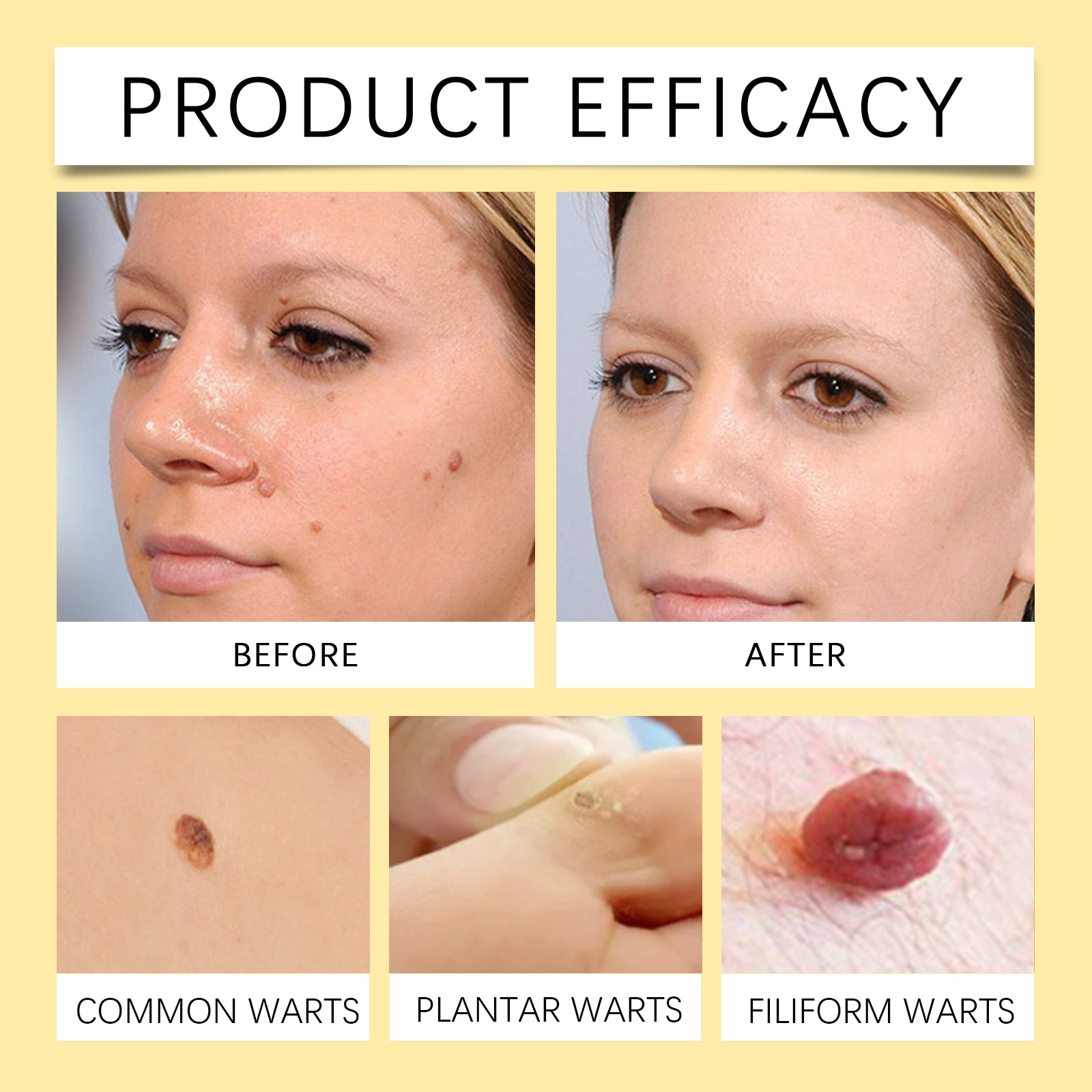 Bee Venom Wart & Mole Removal Spray, Gentle Cleansing Skin Moisturizing Moisturizing Smooth Skin Care