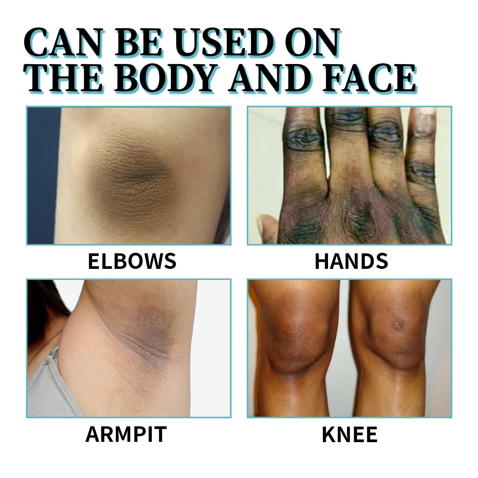 Acanthosis Nigricans Therapy Cream, Repair Dull Skin Lightening Joint Black Moisturizing Whitening Skin Care Cream