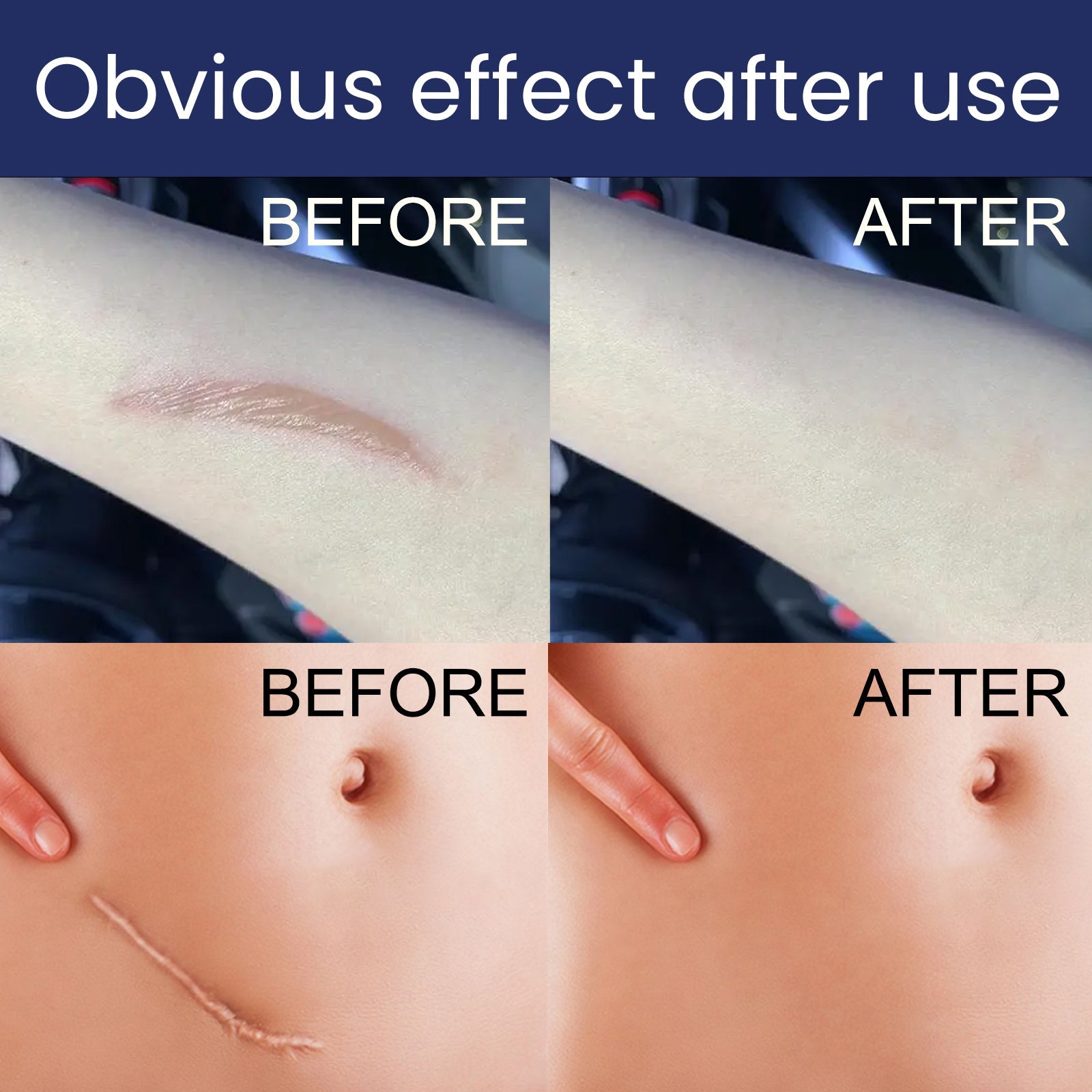 Scar Gel, Fade Skin Scar Pregnancy Surgery Scar Moisturizing Skin Care Gel