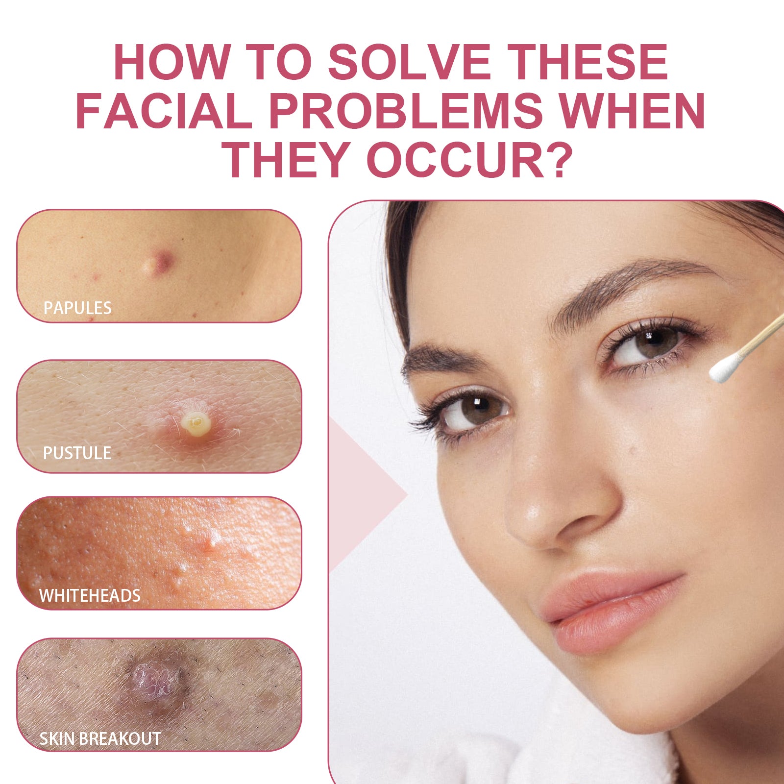 Salicylic Acid Acne Drying Lotion, Gentle Repair Acne-Skin Skin Moisturizing Lotion