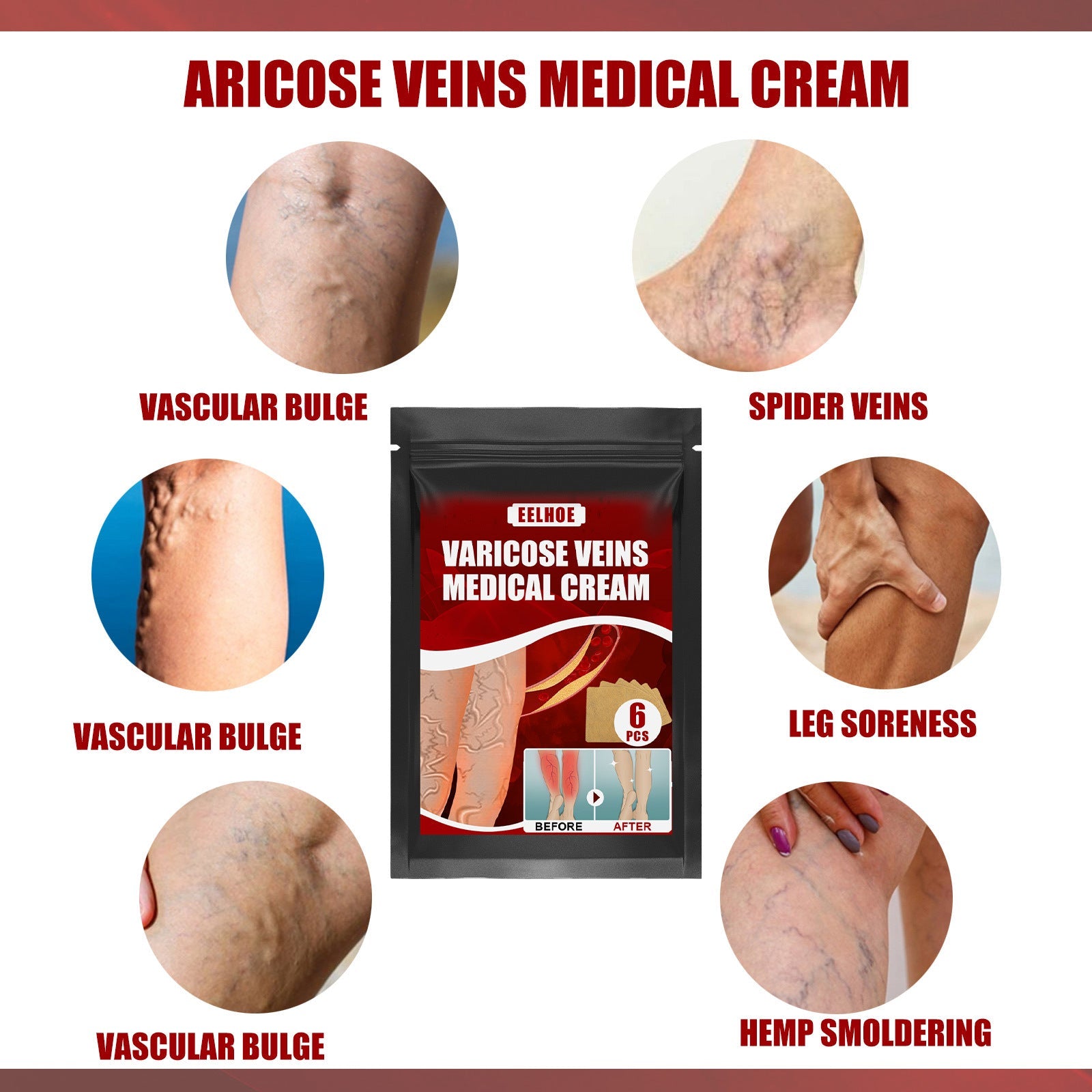Aricose Veins Medical Cream, Relieve Leg Swelling Earthworm Leg Vein Massage To Relieve Pain