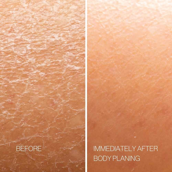 Body Plane Exfoliation Tool Set