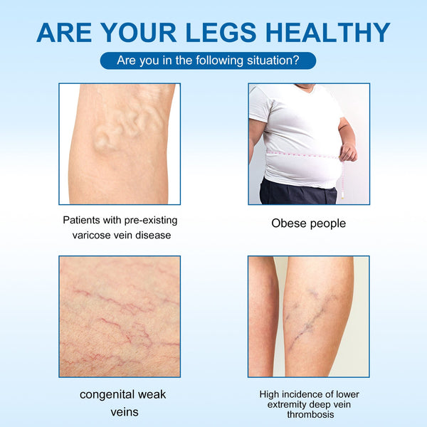 Varicose Vein Slimming Cream, Vein Repair Body Care Reduces Leg Muscle Swelling Earthworm Leg Slimming Cream