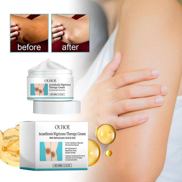 Acanthosis Nigricans Therapy Cream, Repair Dull Skin Lightening Joint Black Moisturizing Whitening Skin Care Cream
