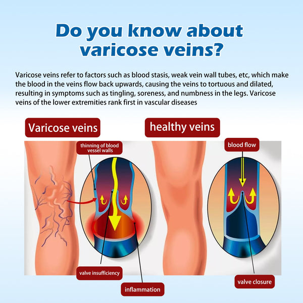 Varicose Vein Slimming Cream, Vein Repair Body Care Reduces Leg Muscle Swelling Earthworm Leg Slimming Cream