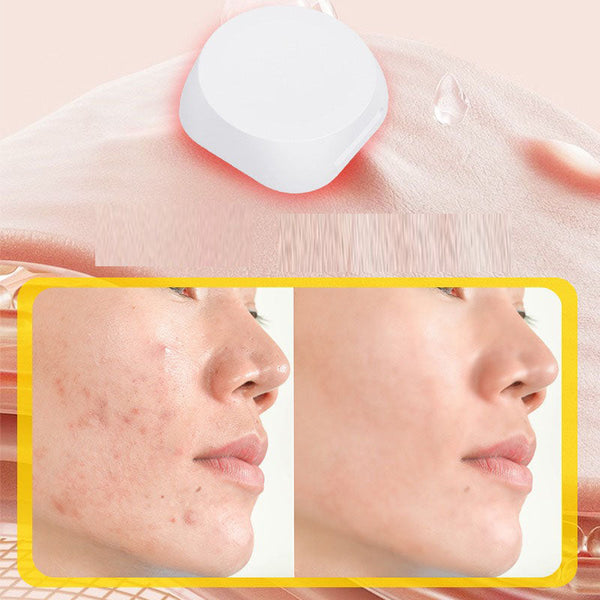Electronic acne patch with red and blue light buttons acne removal patch with acne print water-based gel acne cleaning patch