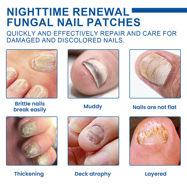 Nighttime Renewal Fungal Nail Patches, Repair And Thickening Gray Nail Insert Soft Nail Care Patch