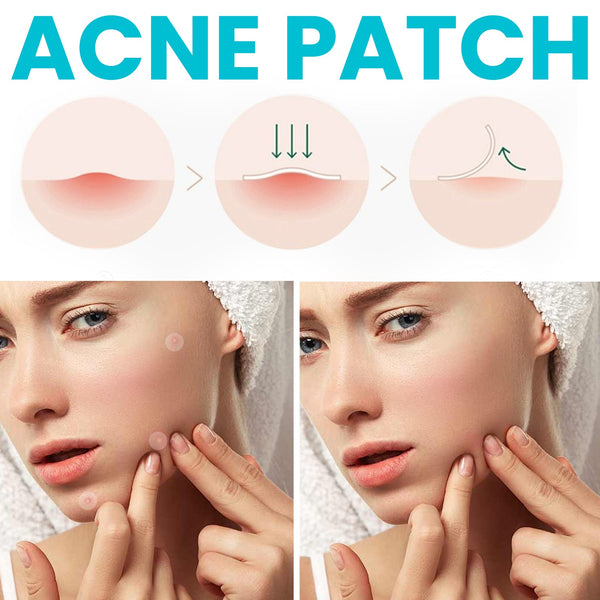 Acne Patch, Repair Facial Acne Invisible Concealer Hydrocolloid Patch