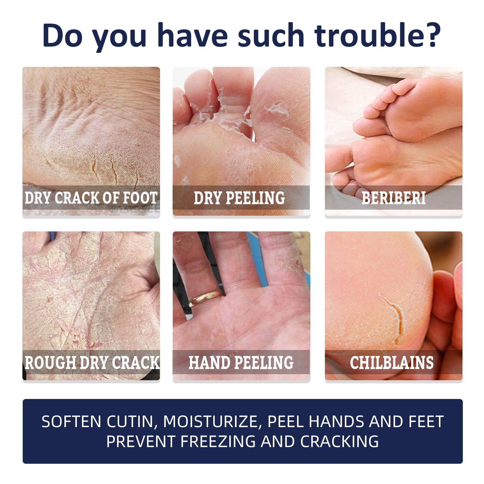 Anti-Crack Repair Hand Cream, Improves Cracked Rough Skin, Removes Dead Skin And Hydrates Hands And Feet Cream