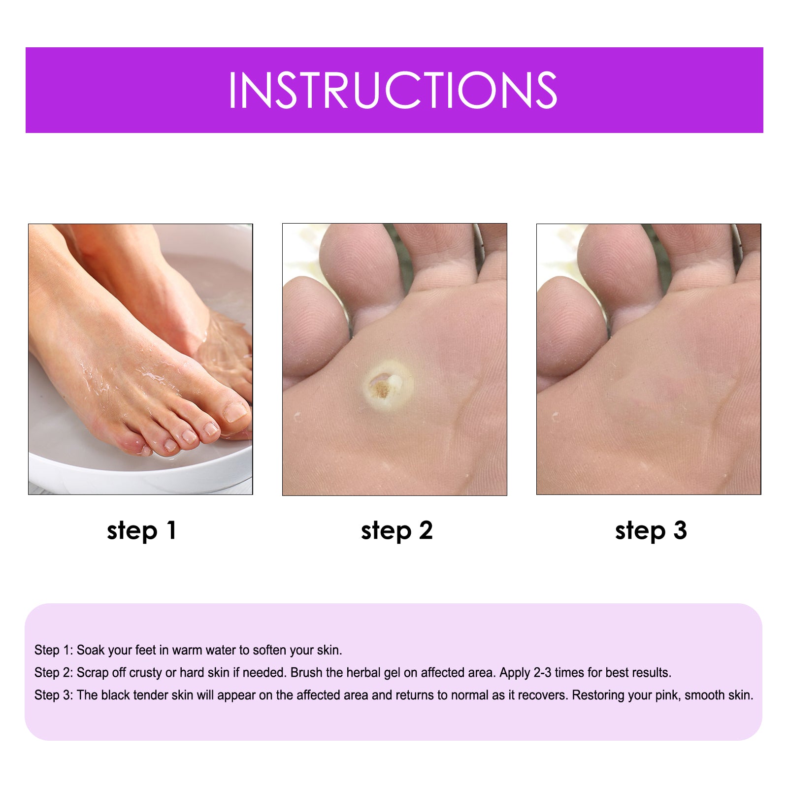 Remove Chicken Eye Lotion Extra Clear Remove Corns Skin Care Chicken Calluses Foot Pad Gram Warts