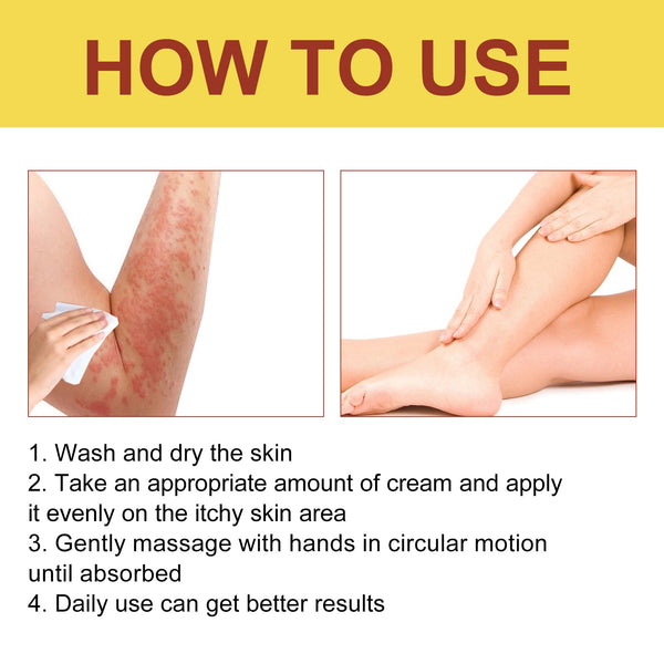 Breaking Itch King, Relieve Hand And Foot Moss Skin Moss Redness Repair Skin Itching Skin Care Cream