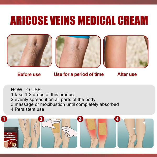 Aricose Veins Medical Cream, Relieve Leg Swelling Earthworm Leg Vein Massage To Relieve Pain