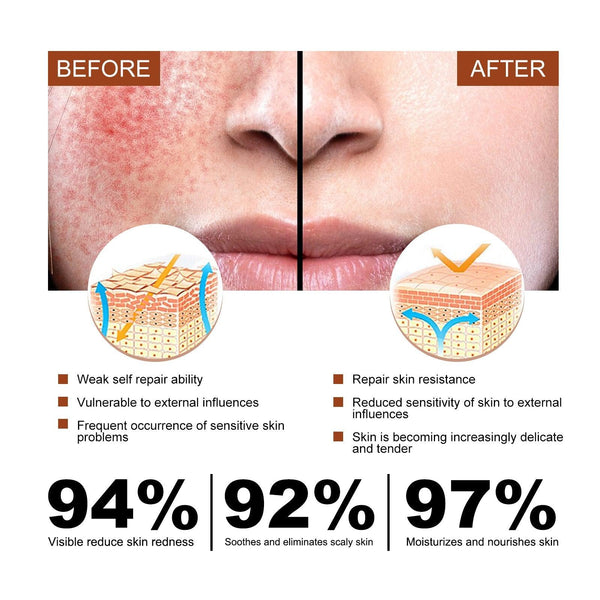 Erythematous Repair Essence, Repair Skin Lighten Facial Erythematous Moisturizing Essential Oil