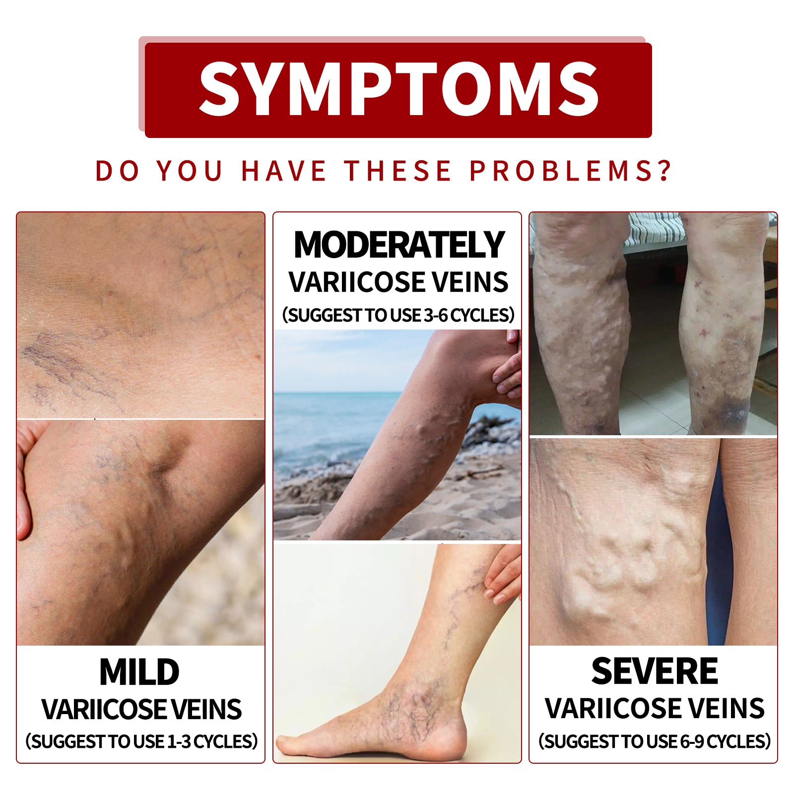 Venous Massage Varicose Cream, Relieves Bulging Leg Blood Vessels And Swollen Leg Earthworm Venous Massage Cream