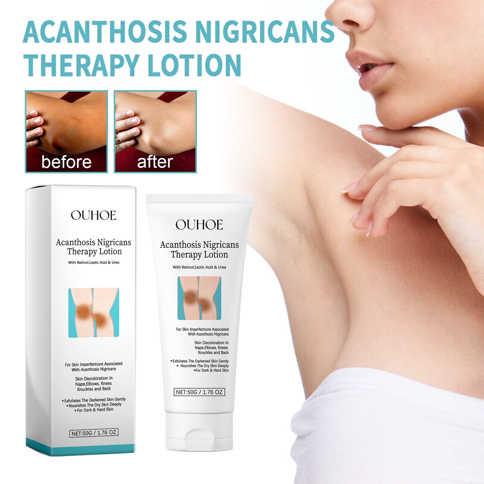Acanthosis Nigricans Therapy Lotion, Skin Moisturizing Clean Black Dark Heavy Alar Knee Joint Repair Carry Bright Color Of Skin