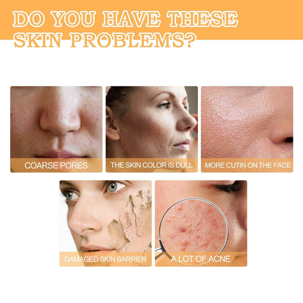 Glycolic Acid 7% Toner, Remove Acne Lighten Acne Repair Acne Mark Moisturize Skin Toner