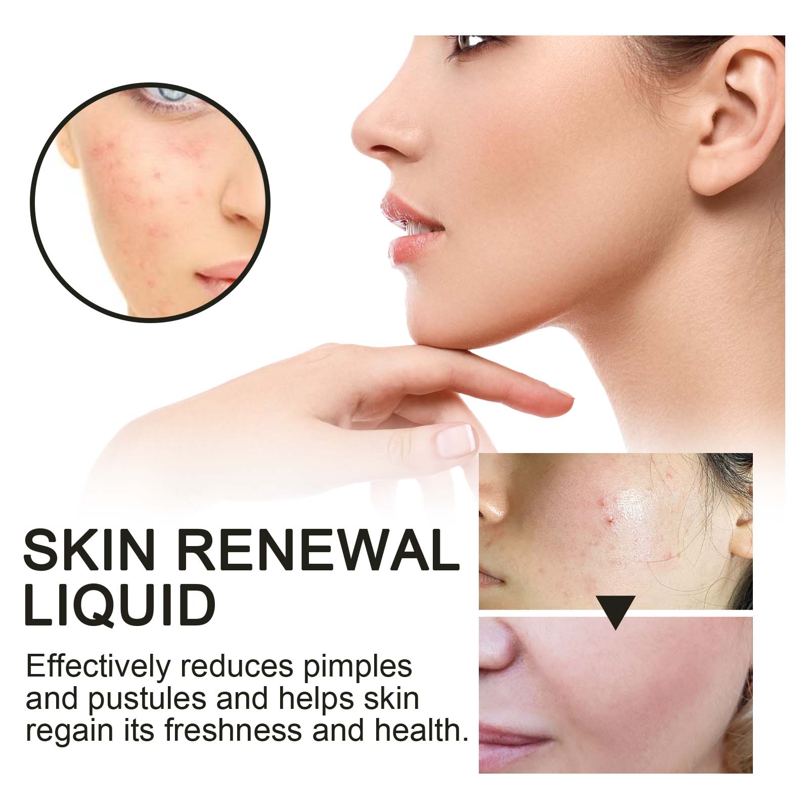 Skin Renewal Liquid, Reduce Acne Print Repair Acne Muscle Mild Clear Acne Hydrating Essence
