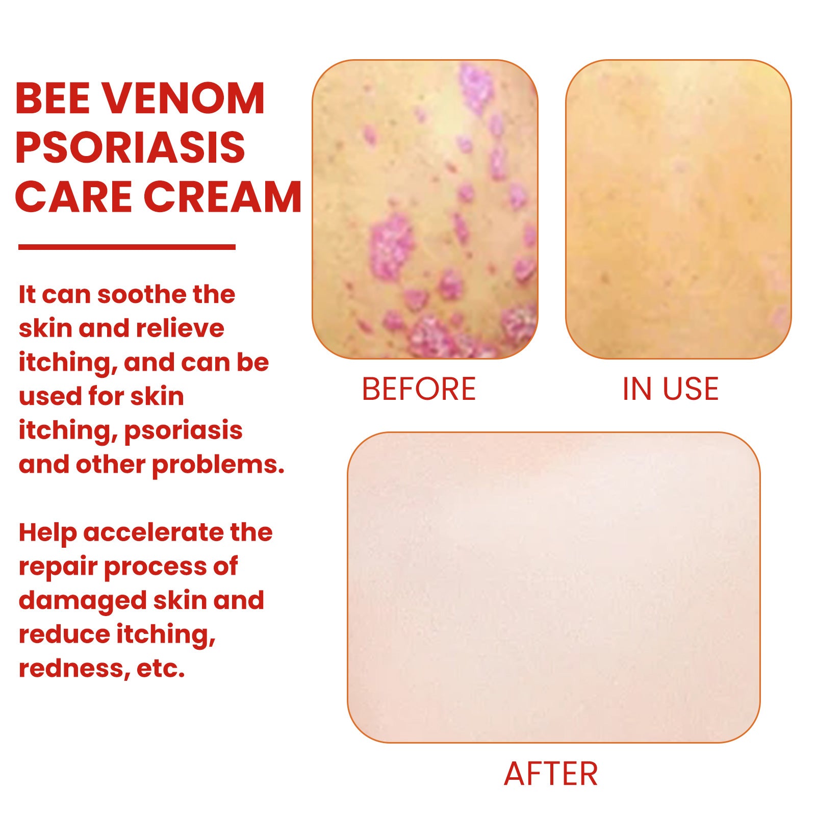 Bee-Poison Cowhide Moss Cream, Which Relieves Redness And Itchiness Of Skin