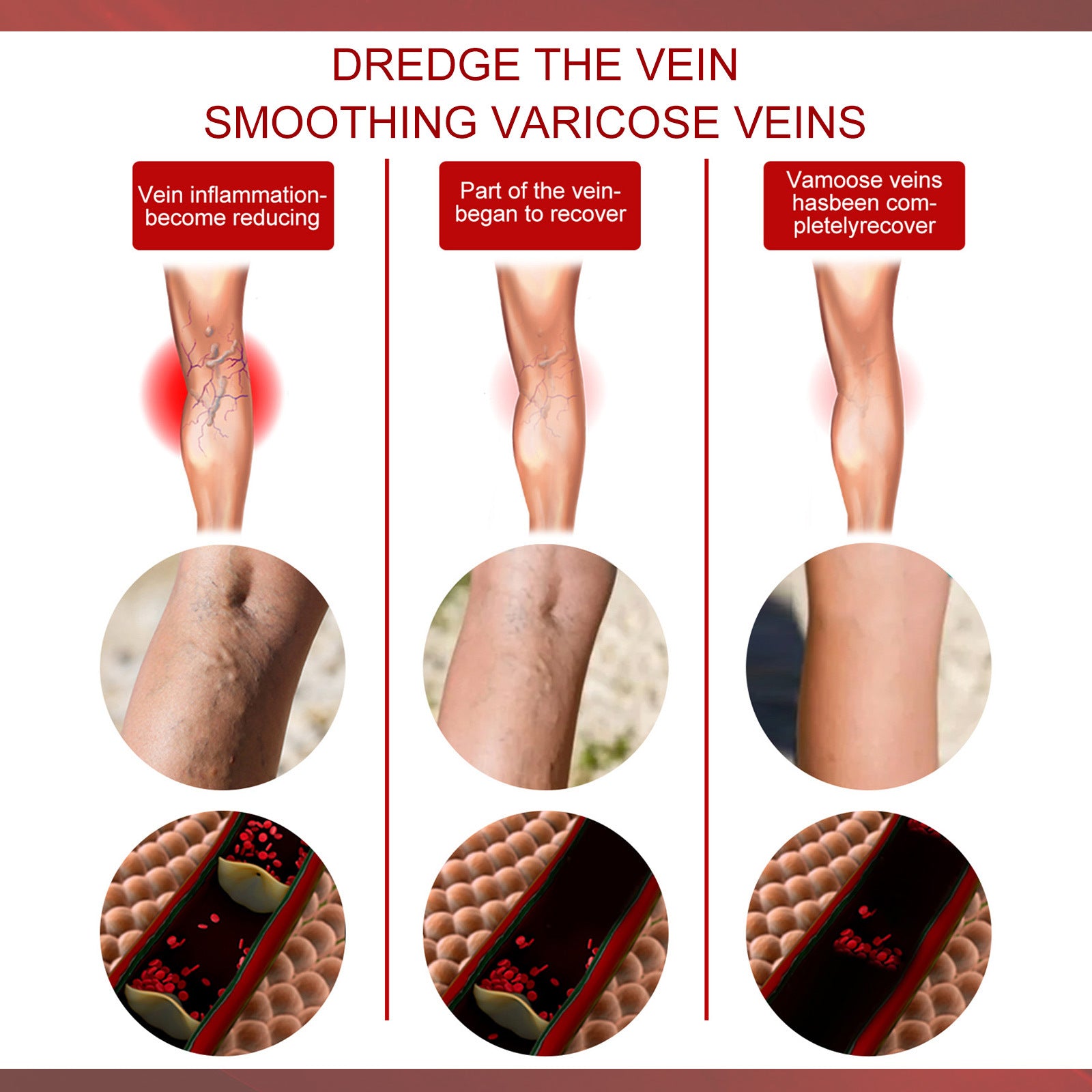 Aricose Veins Medical Cream, Relieve Leg Swelling Earthworm Leg Vein Massage To Relieve Pain