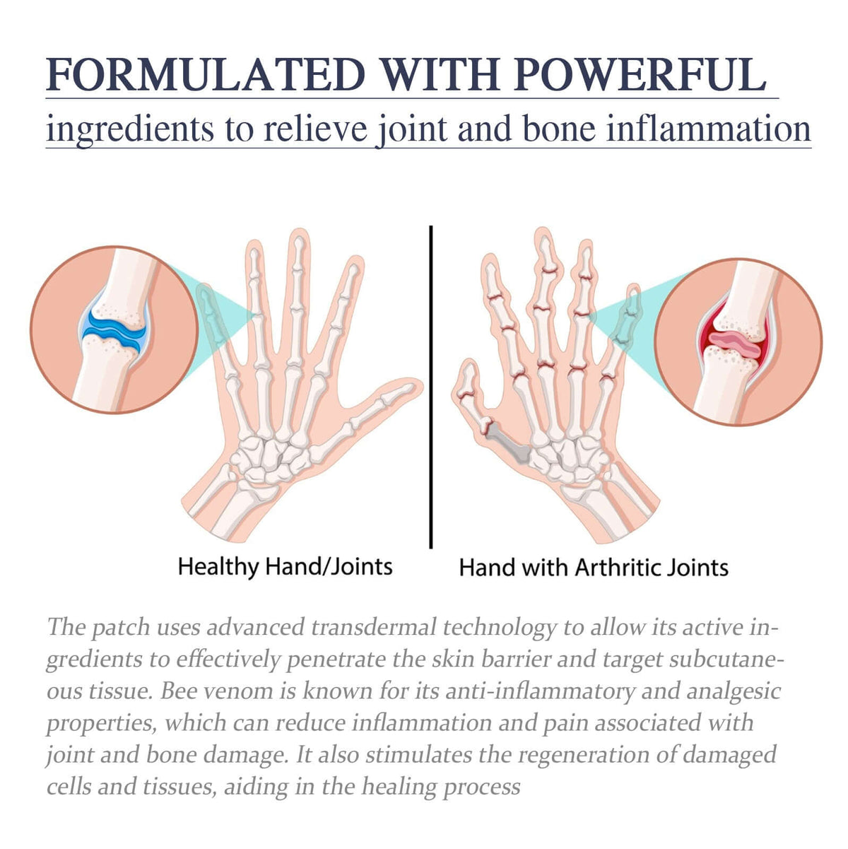 Hands showing joint discomfort treated with Bee Venom Joint Ointment for Deformities for pain and stiffness relief