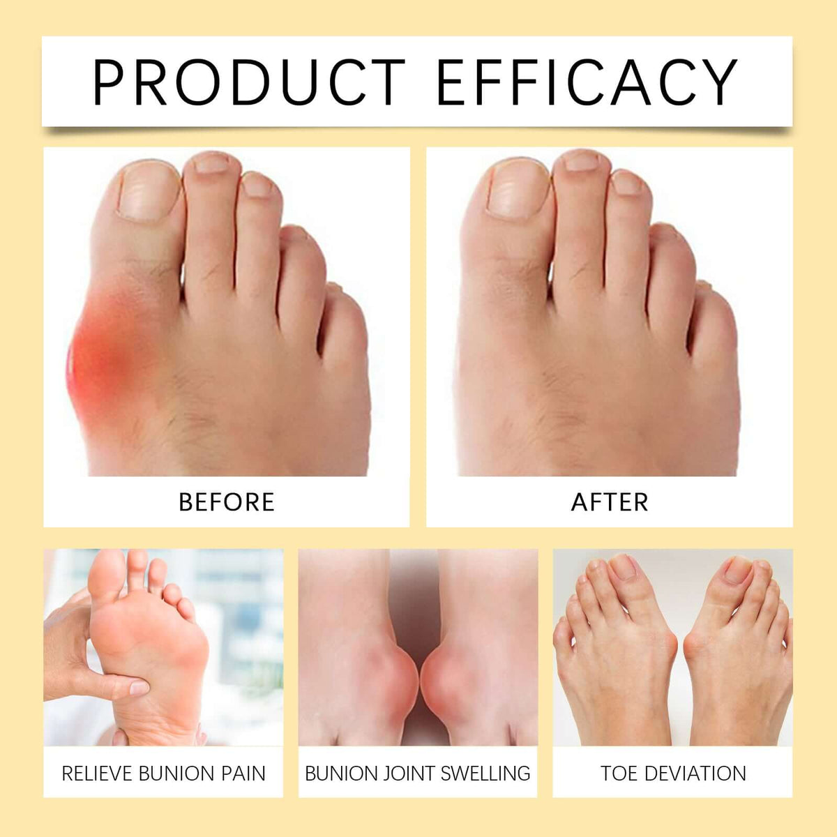 Bunion and sore foot care uses for XIMONTHS bee venom foot cream.